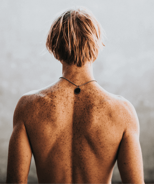 zespół znamion dysplastycznych - atypowych