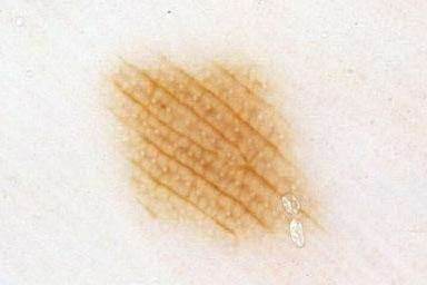 Linie równoległe w bruzdach (ang. parallel furrow pattern - PFP)