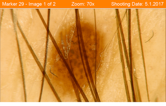 obraz dermatoskopowy znamienia w okolicy pokrytej włosami