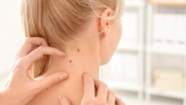 Zwykłe znamiona na szyi