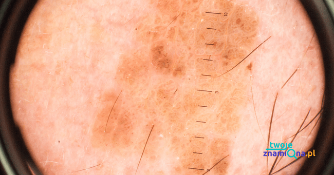 obraz dermatoskopowy