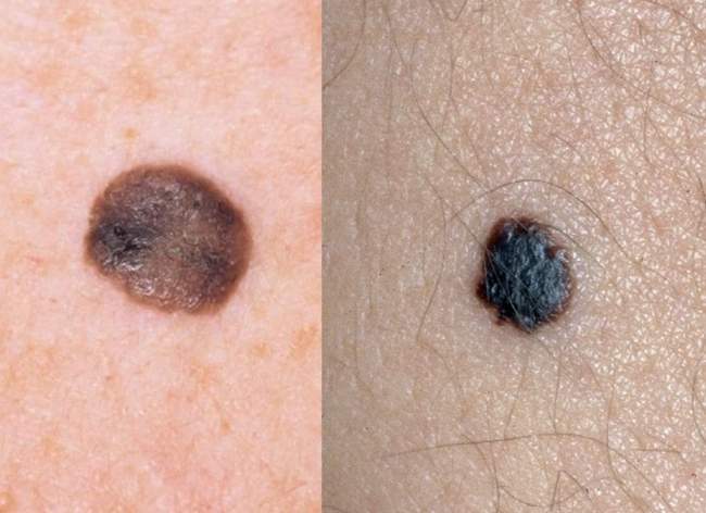 po lewej stronie brodawka łojotokowa, po prawej stronie czerniak