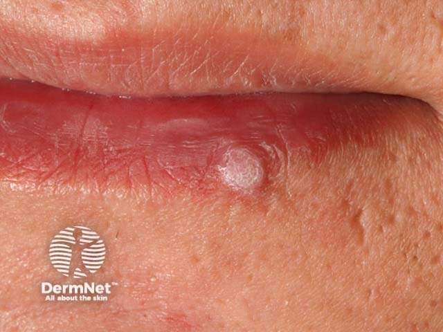 Kurzajka - biała szorstka zmiana wirusowa HPV