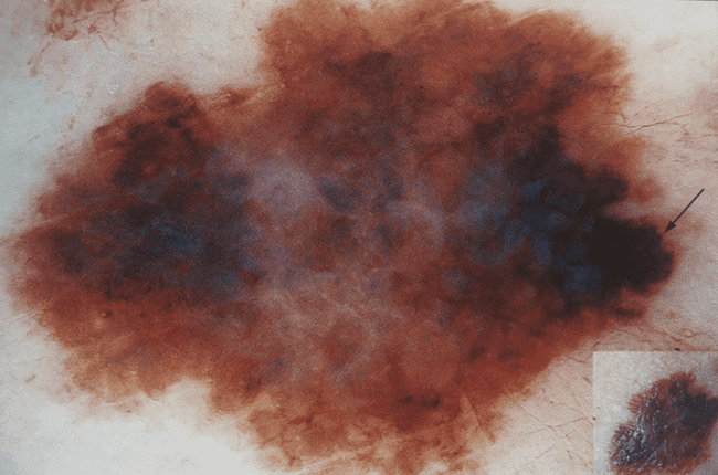 czerniak szerzący się powierzchownie SSM