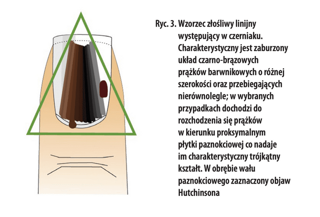 Objawy czerniaka podpaznokciowego.