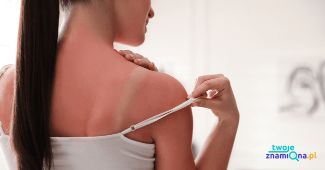 Poparzenie słoneczne