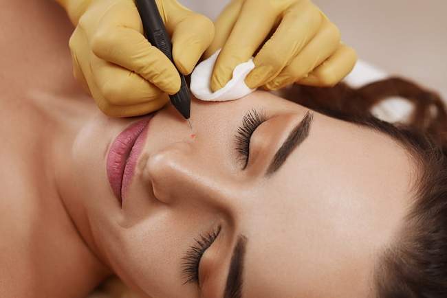 Elektrokoagulacja zabieg - usuwanie znamion prądem elektrycznym wysokiej częstotliwości nieinwazyjne włókniaki brodawki