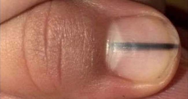 Czerniak podpaznokciowy z objawem Hutchinsona