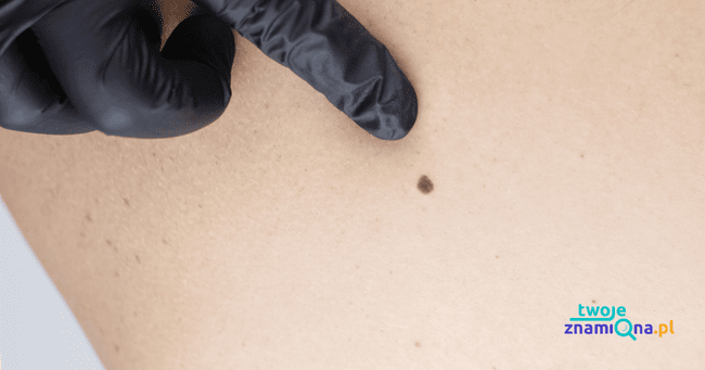 znamię barwnikowe