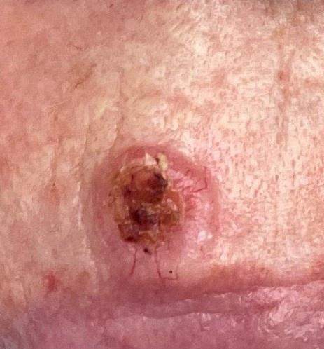 Rak podstawnokomórkowy BCC