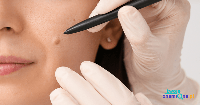 ocena zmiany skórnej