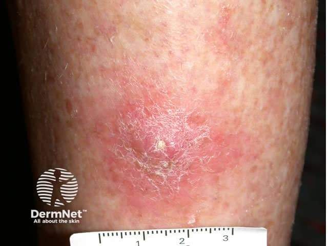 Rak kolczystokomórkowy – owrzodzenie