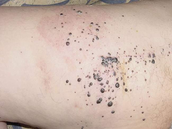 Czerniak skóry - melanoma wizyty kontrolne badanie dermatoskopowe
