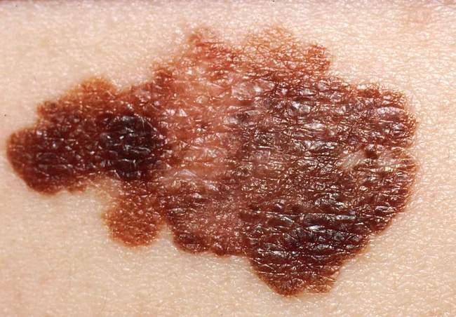 Czerniak skóry - melanoma zdjęcie kliniczne nowotwór barwnikowy