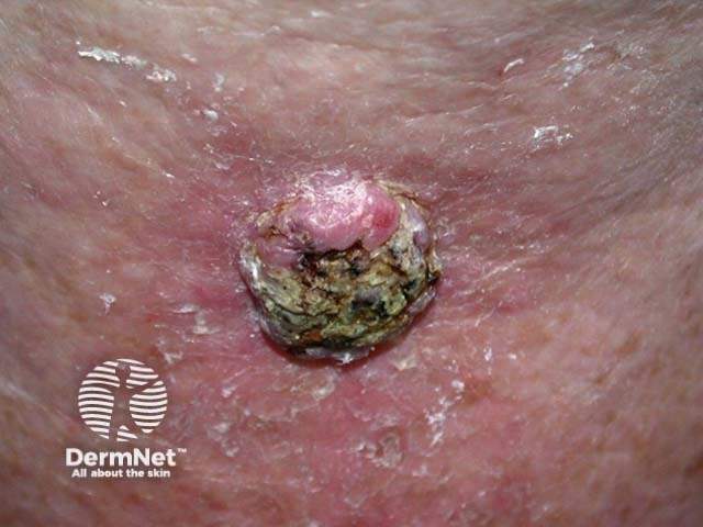 Keratoakantoma lub SCC