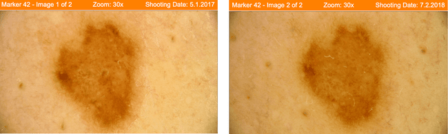 Zdjęcia porównawcze wykonane w trakcie badania kontrolnego po roku od badania poprzedniego.