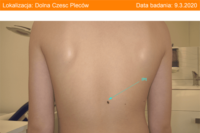 Znamię barwnikowe makroskopowo - marker numeryczny podczas mapowania znamion wideodermatoskopią całego ciała