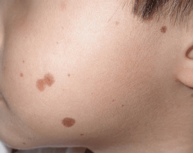 Małe znamiona wrodzone
