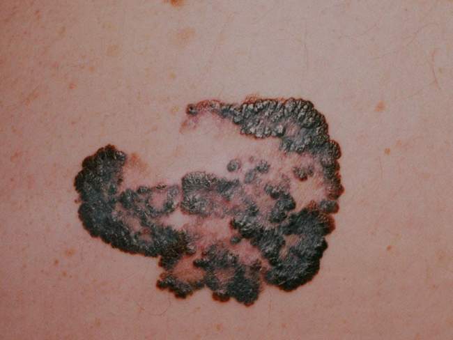 Czerniak skóry - melanoma zdjęcie medyczne nowotwór barwnikowy