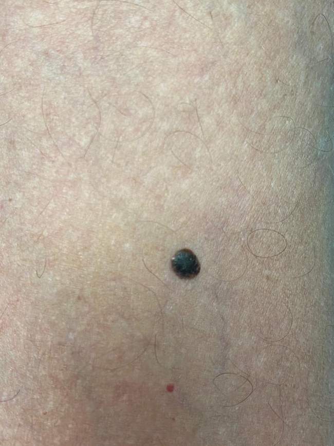 Brodawka łojotokowa - brązowa woskowa zmiana naklejona na skórę