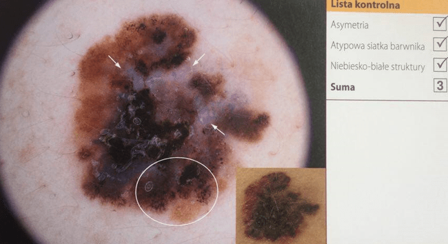 Czerniak złośliwy - ocena na podstawie 3-punktowej skali dermoskopowej. (Dermatoskopia - H.P. Soyer; G. Argenziano; R. Hofmann-Wallenhof; I. Zalaudek)