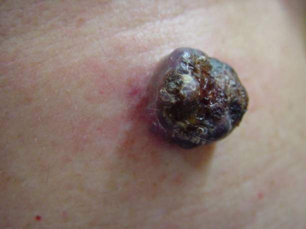 Czerniak guzkowaty - nodular melanoma zdjęcie medyczne postać guzkowa