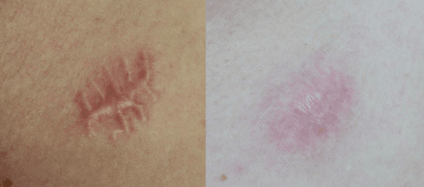 Żródło: BLIZNY WYPUKŁE (FOT. ARCH. TRICLINIUM, marekwasiluk.pl/blizny-wypukle-usuwanie/)