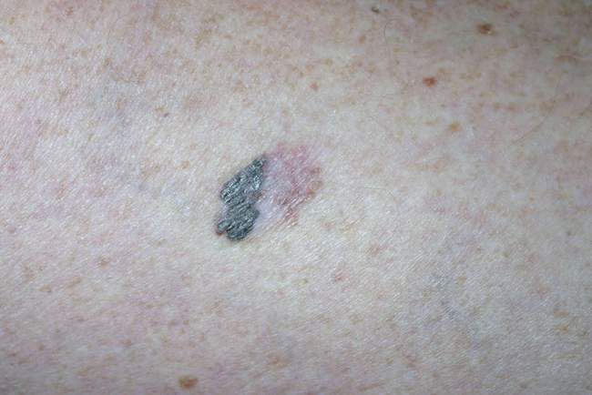 Czerniak asymetryczny z cechami ABCDE