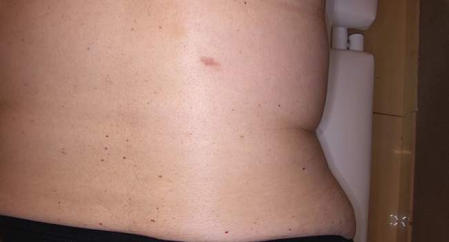 Lokalizacja BCC na ciele