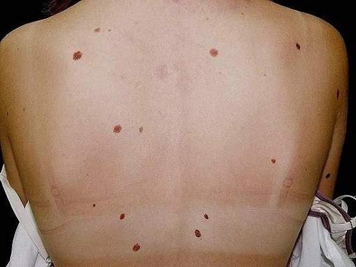 Zespół znamion dysplastycznych