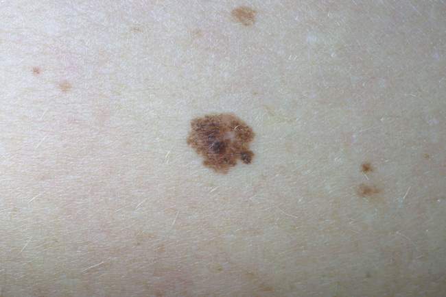 Wczesny czerniak z niejednorodną barwą