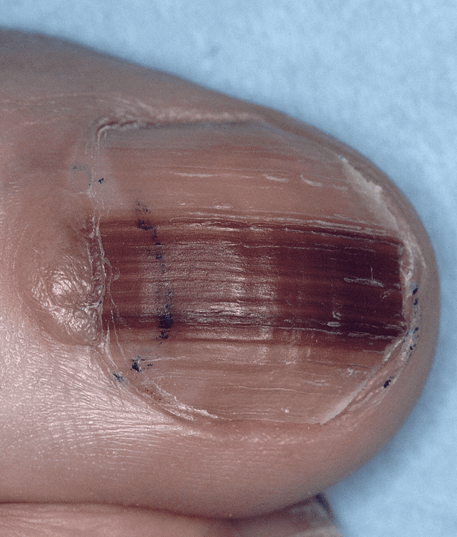 Objawy czerniaka podpaznokciowego.