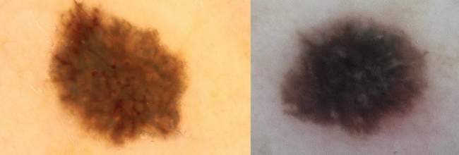 po lewej stronie znamię dysplastyczne, po prawej stronie czerniak.