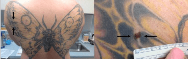 Atypowe znamię skryte w tatuażu