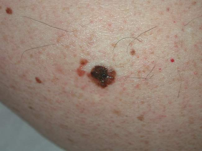 Czerniak skóry - melanoma zdjęcie dermatologiczne przykład kliniczny