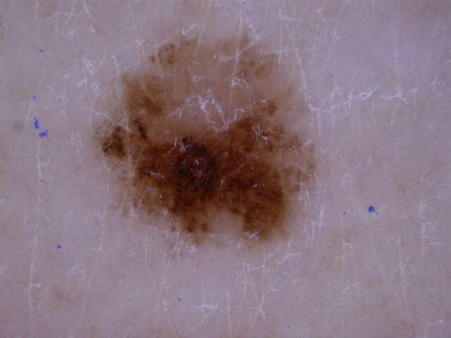 Czerniak skóry - melanoma przerzuty błony śluzowe węzły chłonne