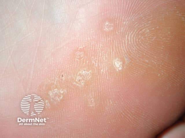 Kurzajka podeszwowa na stopie - bolesna zmiana wrastająca w głąb skóry