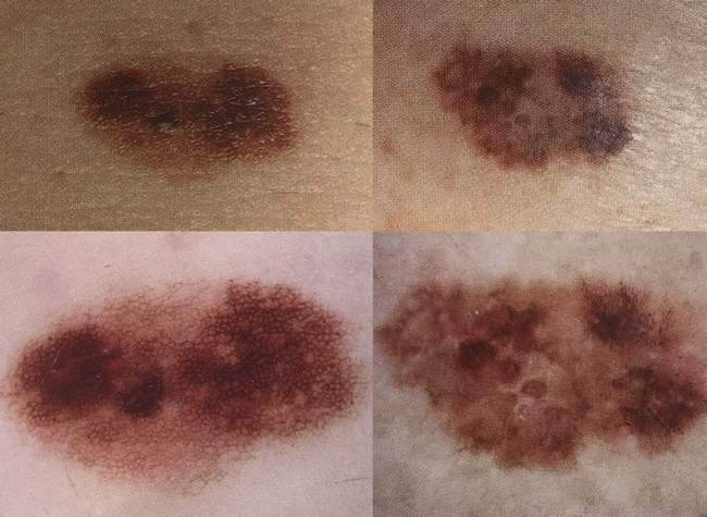 po lewej stronie znamię, po prawej stronie czerniak