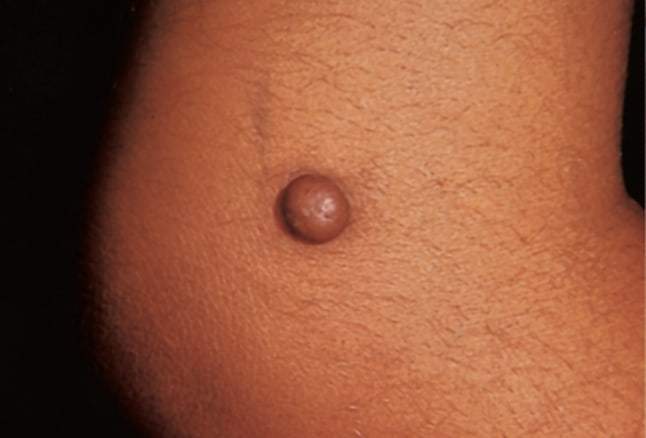 to jednak nie czerniak