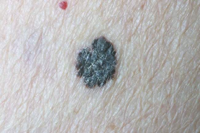 Czerniak złośliwy - melanoma zdjęcie medyczne