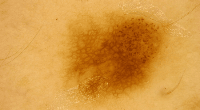 Zwykłe znamię barwnikowe - typowy pieprzyk zdjęcie dermatologiczne