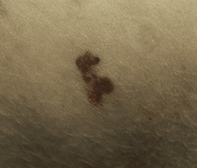 Czerniak złośliwy - melanoma wczesna postać zdjęcie dermatologiczne ABCDE